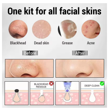 Derma Suction Blackheads.